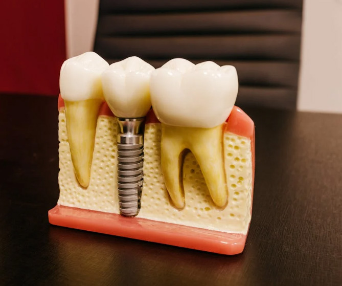 Dental Implants