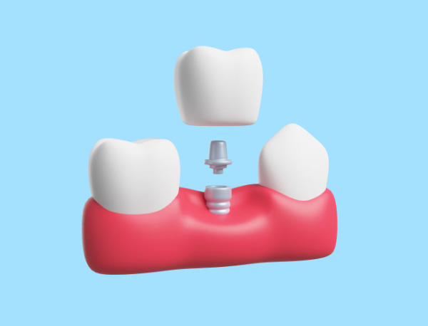 Dental Crown Instalation